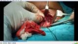 Thyroid Surgery Video by ear nose throat specialist Dr Santanu Bhattacharjee Kolkata